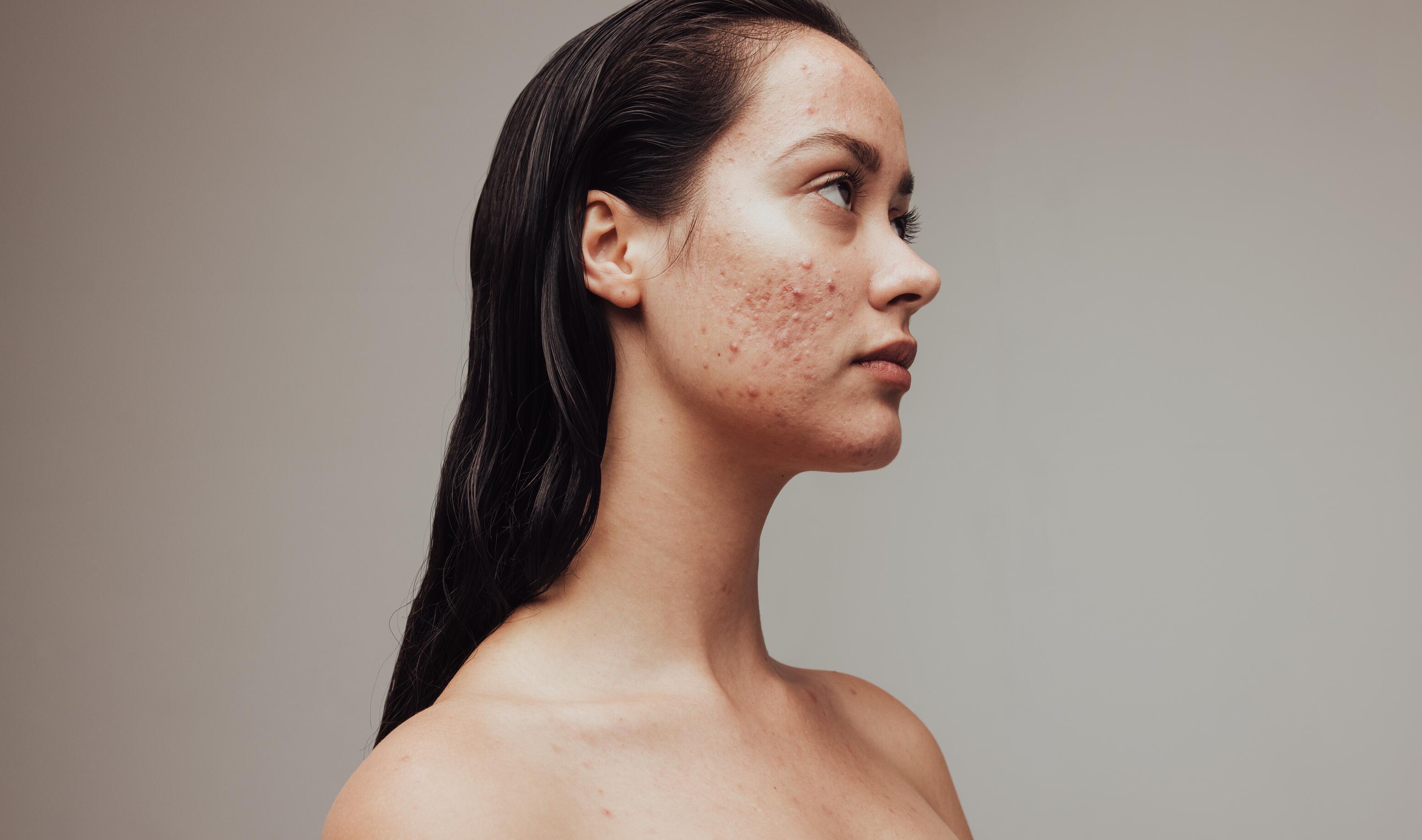 Acné du visage : causes, traitements et conseils